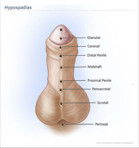 Hypospadias